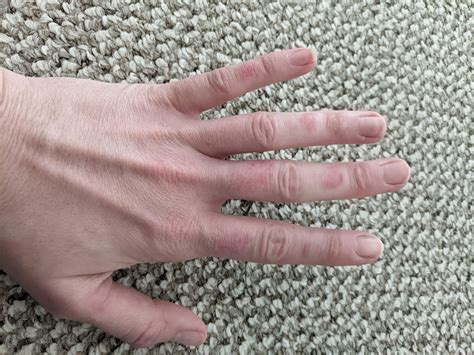 What is this rash on my fingers? It's killed off all the little finger ...