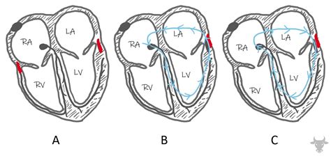 Ventricular Pre-excitation | ECG Stampede