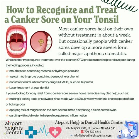 Pin on Canker sore