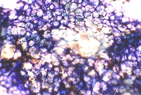 Carbamazepine-induced Pure Red Cell Aplasia in a young girl