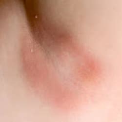 Fungal Skin Infections: Symptoms, Types & Treatment Options