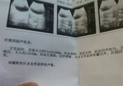 怀孕一个月b超图片真实图片（怀孕一个月b超图 让你一眼看懂b超图） | 说明书网