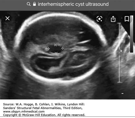 Ultrasonography Vs Ultrasound