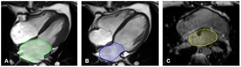 Quantification of Left Atrial Size and Function in Cardiac MR in ...
