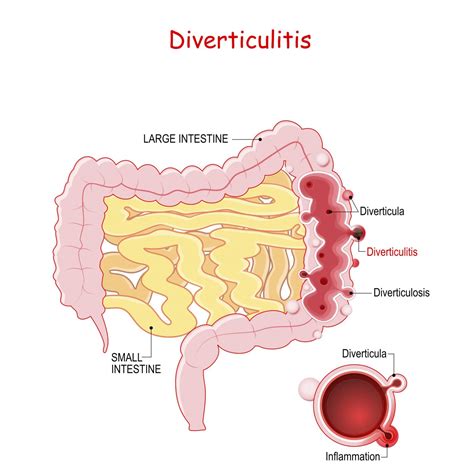 What Does Extensive Diverticular Disease Mean - Design Talk
