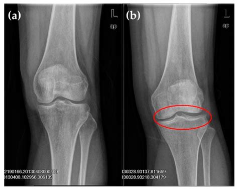 Osteoarthritis Knee Xray