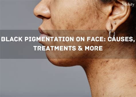 Black Pigmentation on Face: Causes, Treatments & More - Miduty