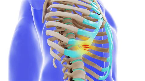 What is SRS | Slipping Rib Syndrome