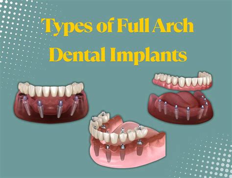Types of Full Arch Dental Implants: Which Option is Right for You? - crystalline Dental