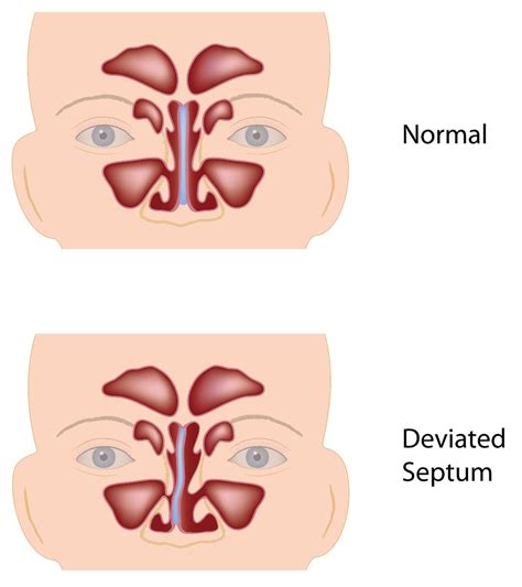 Deviated Nasal Septum: Symptoms, Causes And Treatment - Boldsky.com