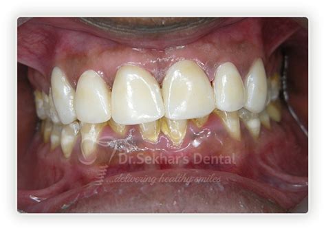 Smile Gallery - Dr Sekhars Dental Implant Center