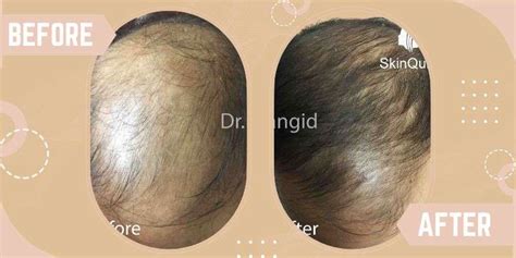 PRP Treatment for hair loss in Saket, South Delhi | SkinQure