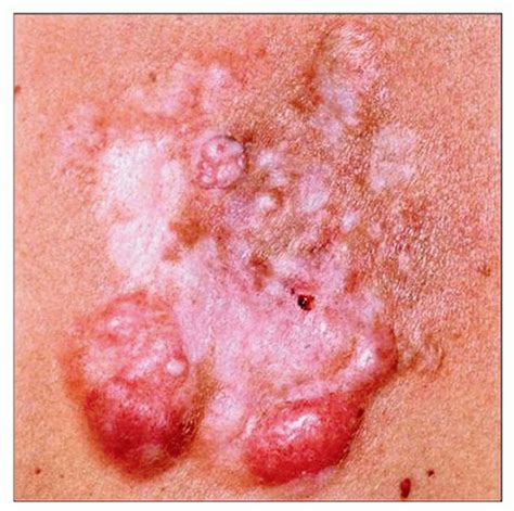 Image result for Dermatofibrosarcoma Protuberans