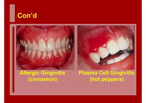 Lecture xiii ju-oral pathology-lecture xiii-perio5 | PDF