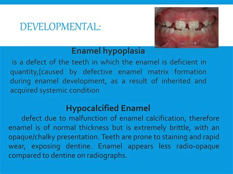 Enamel white lesions | PPTX