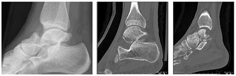 Talus Bone Fracture Nhs at Michelle Ma blog