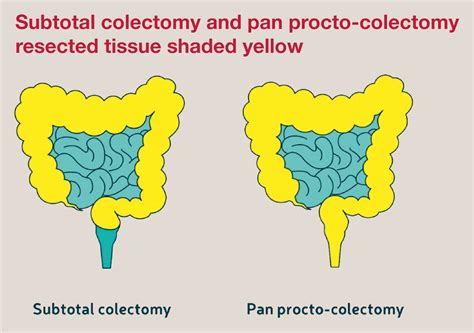 Ileoanal Pouch Surgery For Ulcerative Colitis at Mitchell Dorgan blog