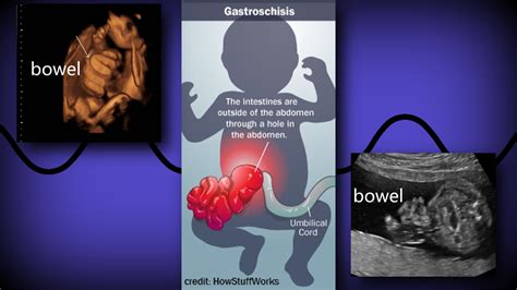 Omphalocele vs. Gastroschisis – Sonographic Tendencies