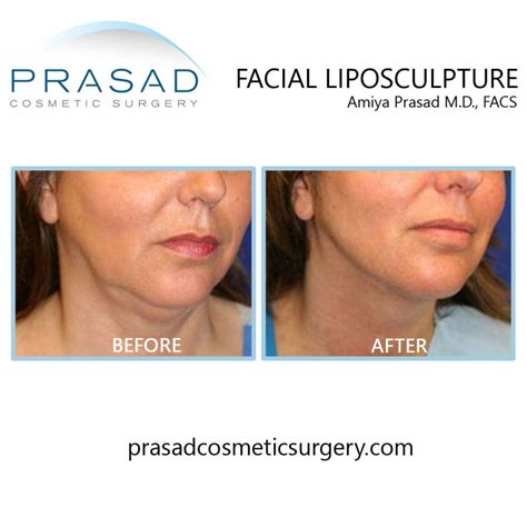 Double Chin Removal: Surgical and Non-Surgical Treatments