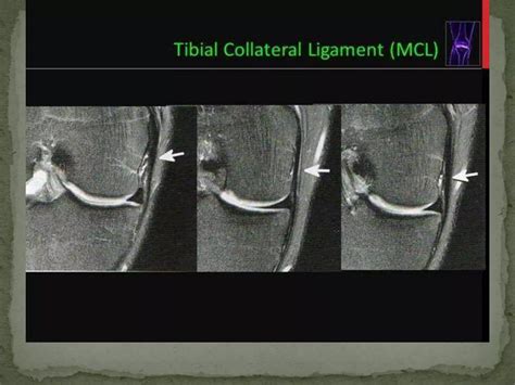 Anatomy and imaging of knee joint | PPTX
