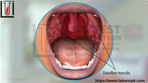 Mononucleosis Symptoms & causes