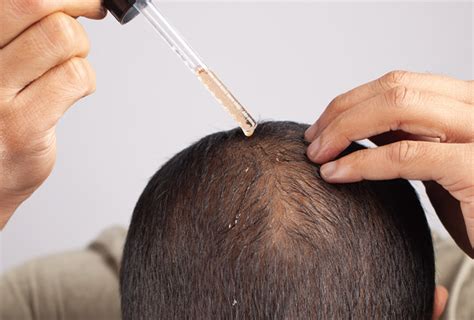 How To Know If You Have Male Pattern Baldness