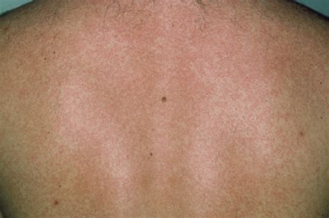 Bildergebnis für rubella symptoms