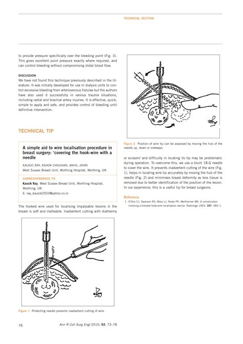 Image result for Wire Loc Procedure