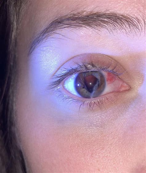 Eye scar – Artofit