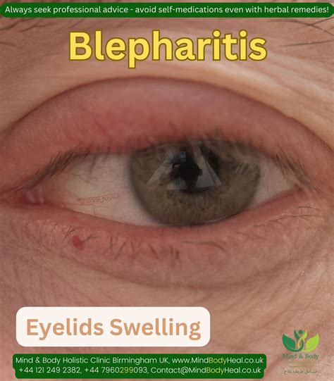 The Ultimate Guide To Effective Eyelids Swelling Treatment - Watson Media