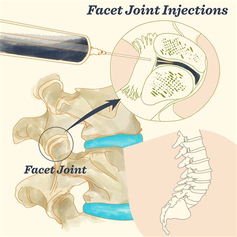 Facet Joint Injection guideline ~ akufisio.blogspot