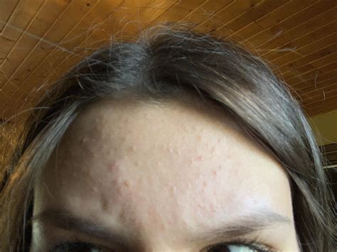 [acne] help!! Closed comedones or fungal acne? Tried everything (nizoral, stridex pads and so ...