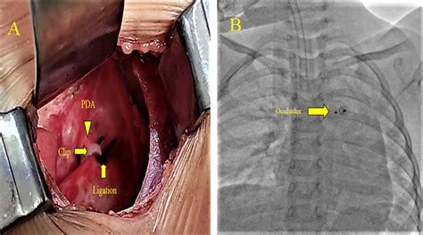 Image result for Closure Procedure