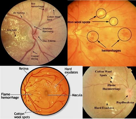 Cotton Wool Spots Vs Hard Exudates