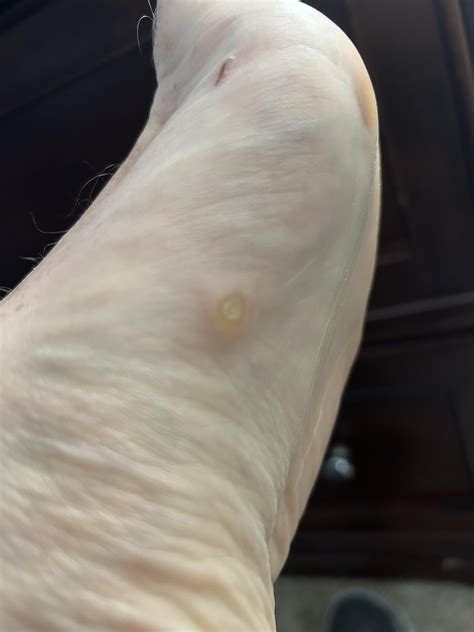Wart or Callus : r/Warts