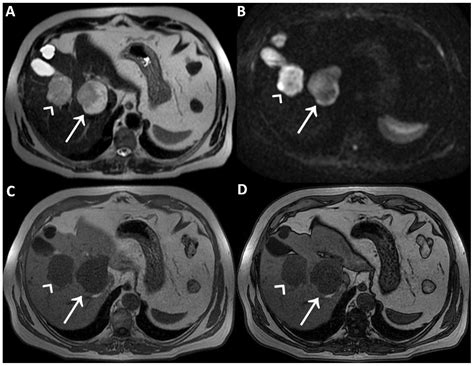 The Influence of Gd-EOB-DTPA on T2 Signal Behavior: An Example from ...