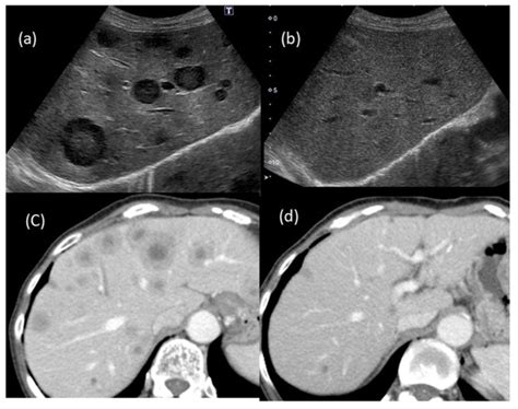Multiple Inflammatory Pseudotumors of the Liver Demonstrating ...