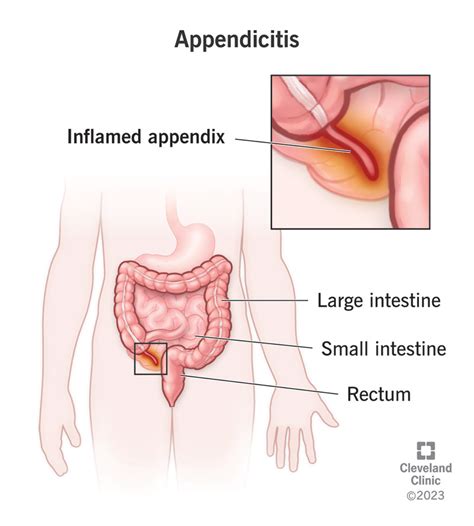 Image result for Appendicitis