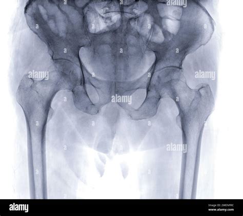 Normal hip x ray hi-res stock photography and images - Alamy