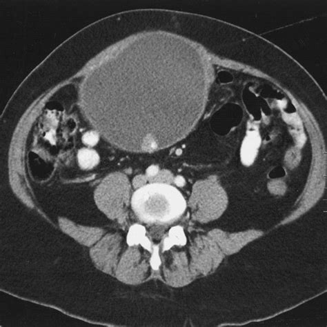 Bildergebnis für ruptured abscess on colon