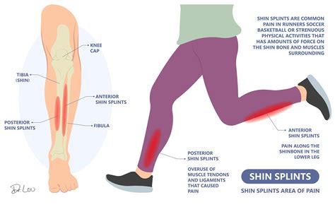 Posterior Shin Splints Stretches