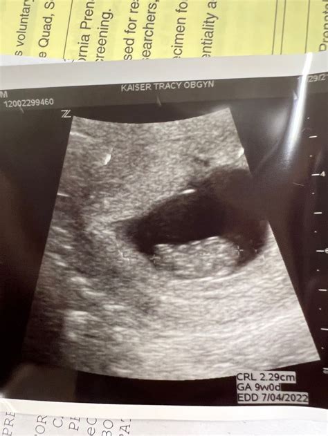 9 Weeks Pregnant Ultrasound 2022