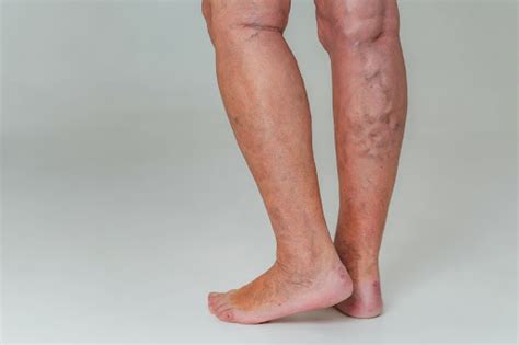 MedfinWhat Is The Root Cause Of Varicose Veins? - Varicose Vein Causes ...