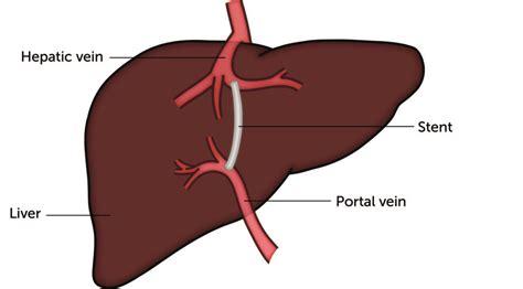 Image result for Tips Procedure Recovery