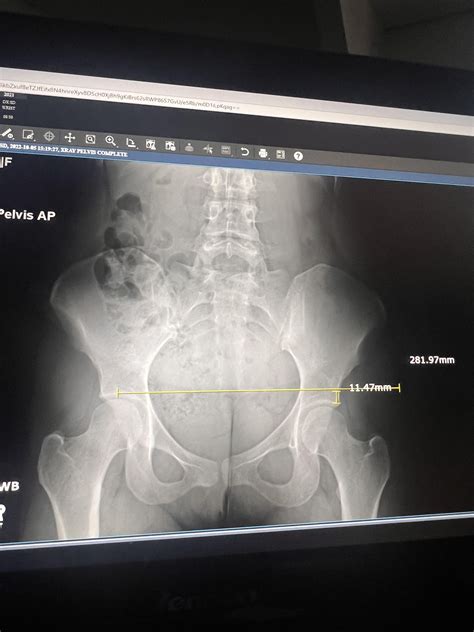 hip x rays : r/AskDoctorSmeeee