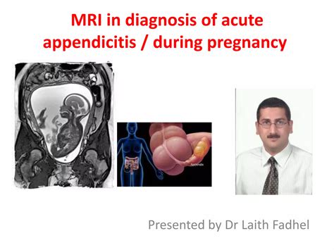 Mri in diagnosis of acute appendicitis during pregnancy | PPTX