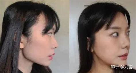 方脸做下颌角磨骨手术1年前后对比照片,原来的方脸变圆脸了 - 面部整形 - 无忧爱美网