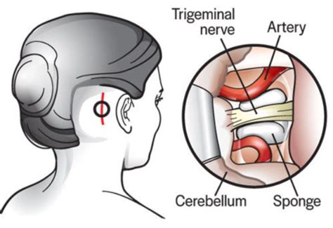 Potential Risks and Complications of Trigeminal Neuralgia Surgery