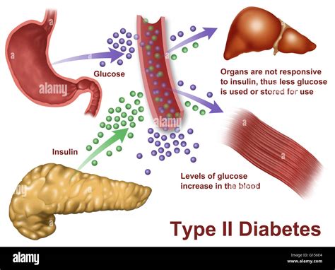 Type 2 Diabetes Pancreas