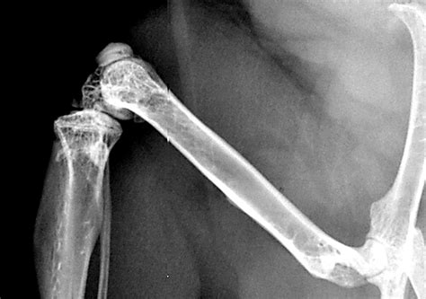 Bad Broken Bone X Ray